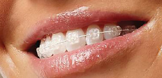 Cum functioneaza aparatele dentare?